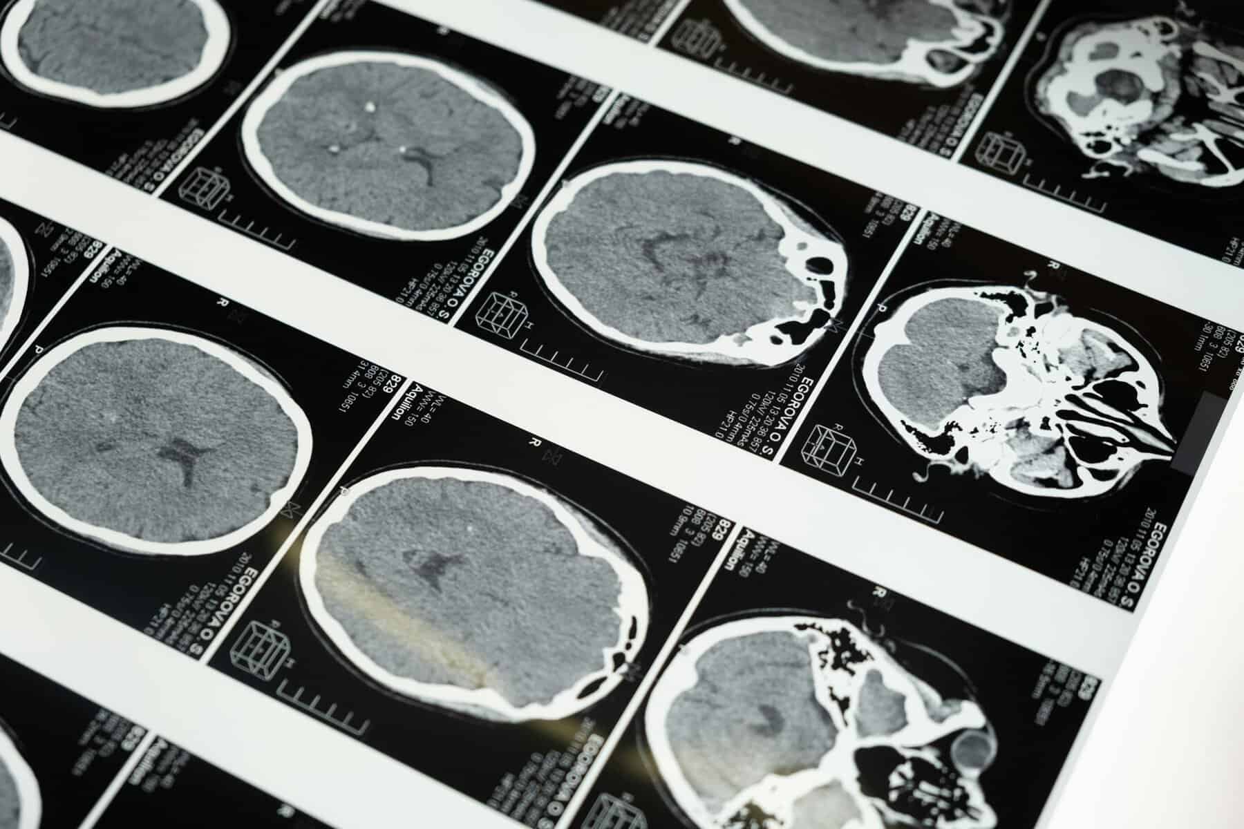 cerebro guardar recuerdos, cerebro envejecido