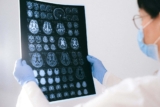 La detección de Alzheimer ya es posible a través del análisis de sangre