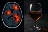 El consumo de alcohol puede duplicar el riesgo de daño cerebral